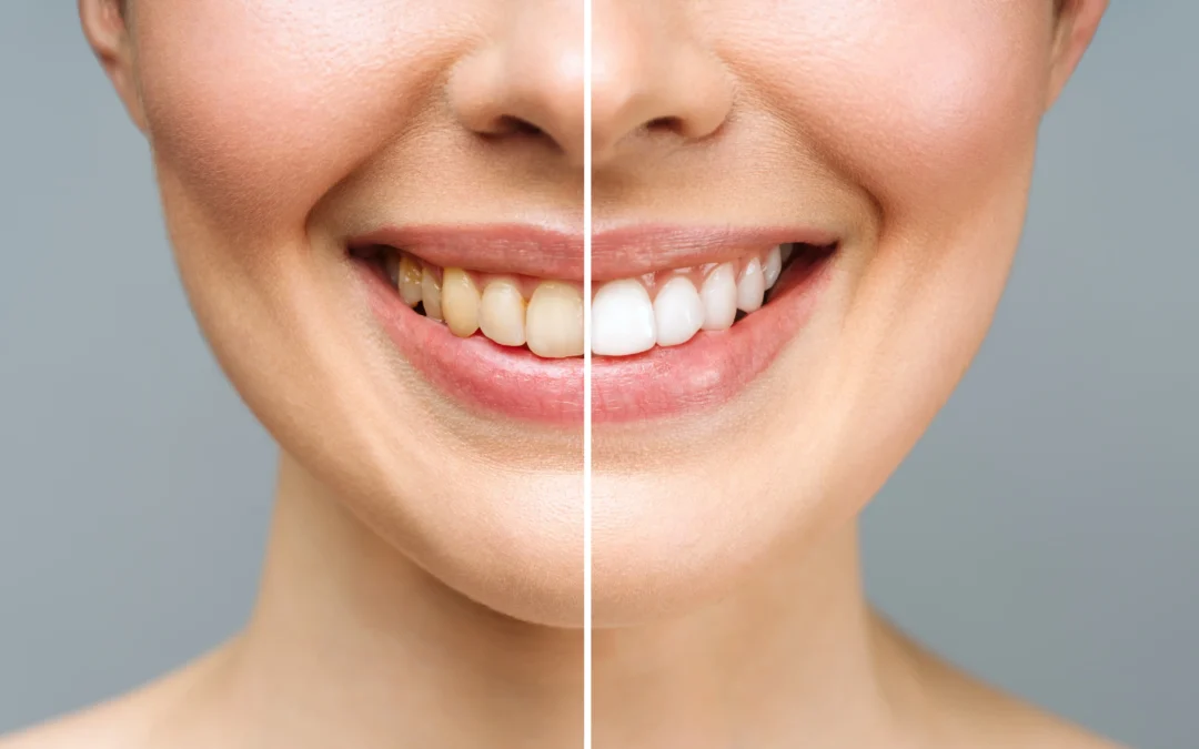 Woman's smile comparison showing teeth before and after professional teeth whitening treatment, highlighting improved brightness and confidence, relevant to teeth whitening services in Enfield, CT.