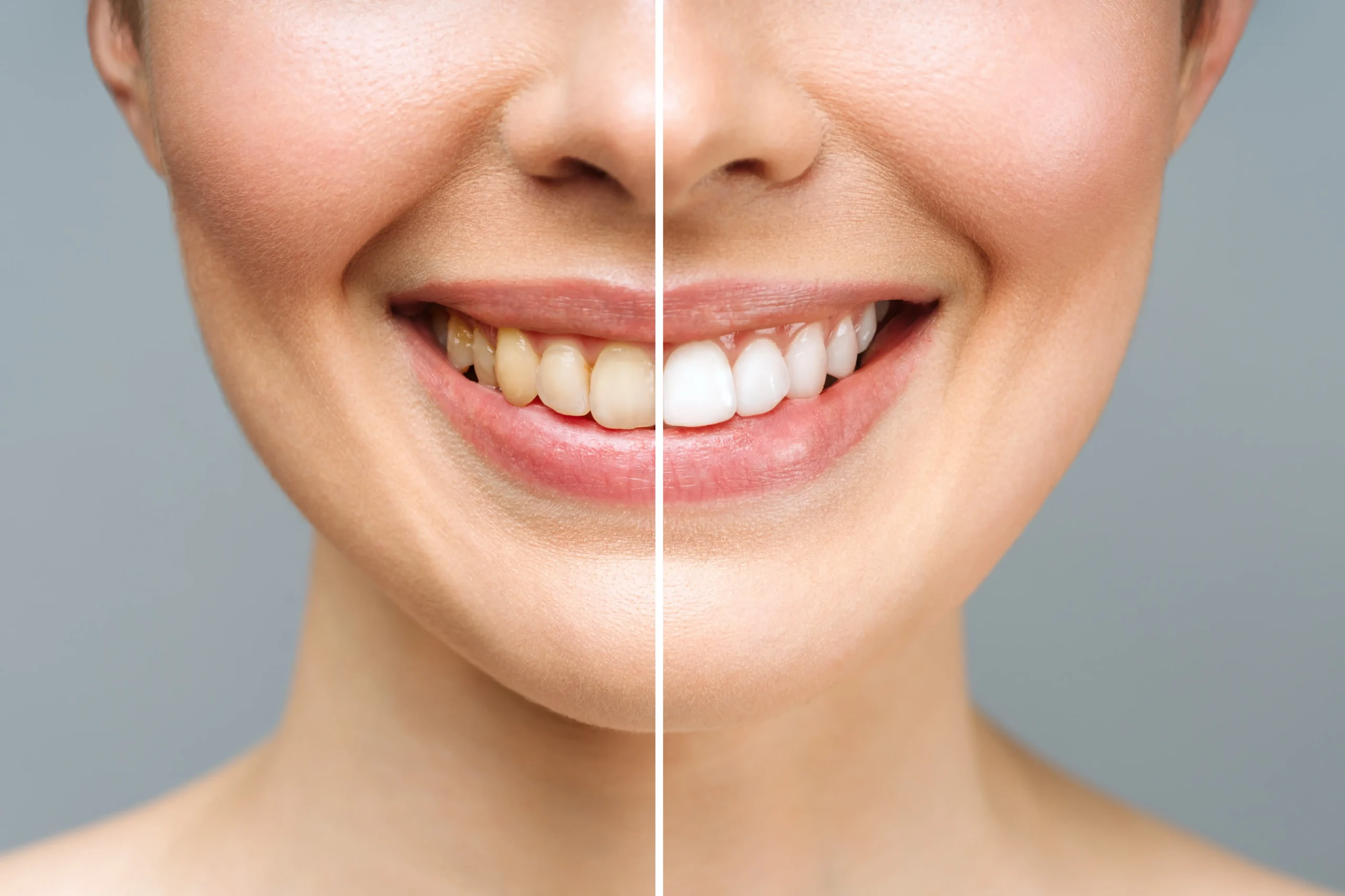 Smiling woman showing before and after teeth whitening results, highlighting a bright, white smile on one side and yellowed teeth on the other, emphasizing Zen Dental's professional whitening services.
