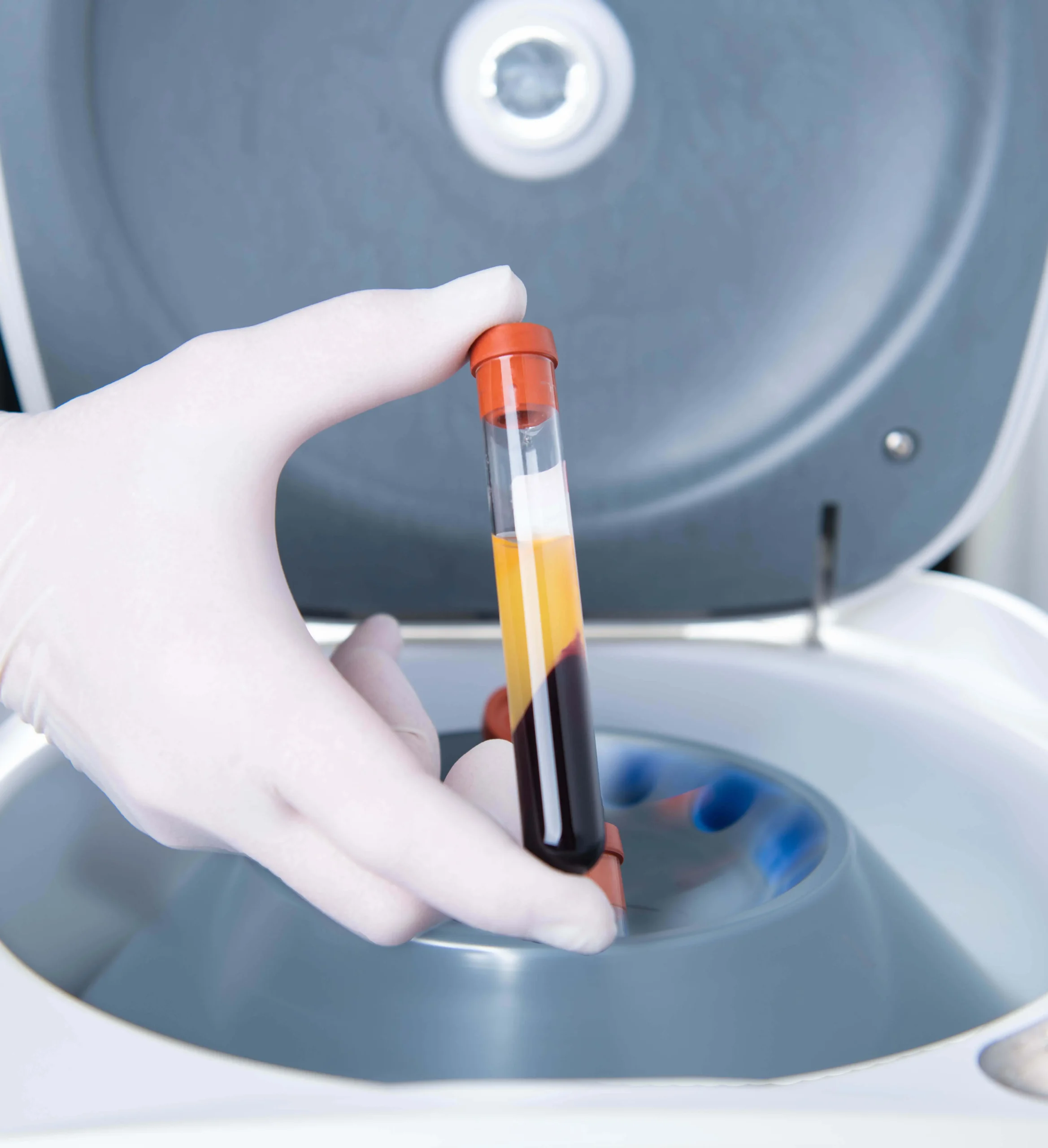 Gloved hand holding a test tube with layered blood components, positioned near a centrifuge, illustrating Advanced Platelet-Rich Fibrin (APRF) treatment process for enhanced healing in dental procedures.